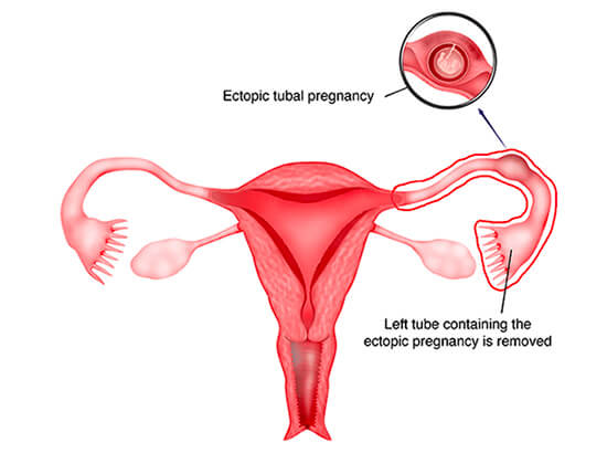 Ectopic Pregnancy Saharanpur