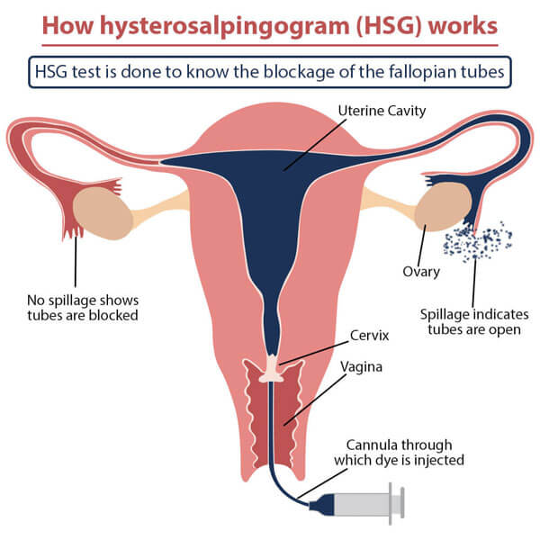 Hysterosalpingogram/ HSG