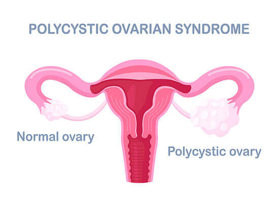 PCOS / PCOD